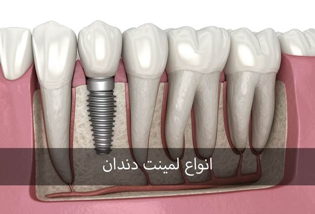 ایملپنت دندان و عوارض 